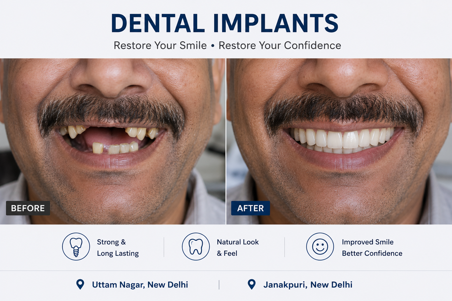 Dental implant treatment at Sharanya Dental and Implant Care, Uttam Nagar and Janakpuri, West Delhi
