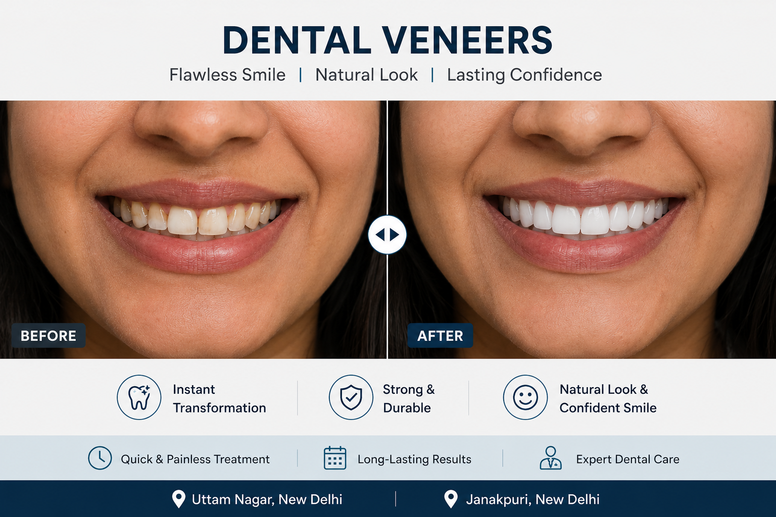 Dental veneers treatment at Sharanya Dental and Implant Care, Janakpuri, West Delhi