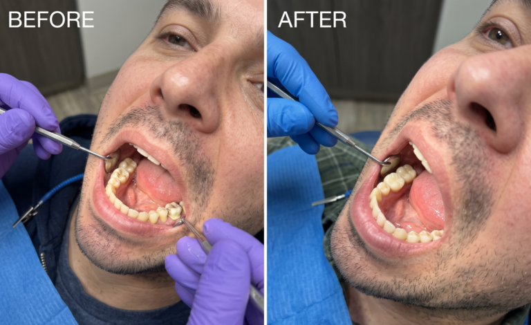 Back tooth cap after root canal: before and after (illustration)