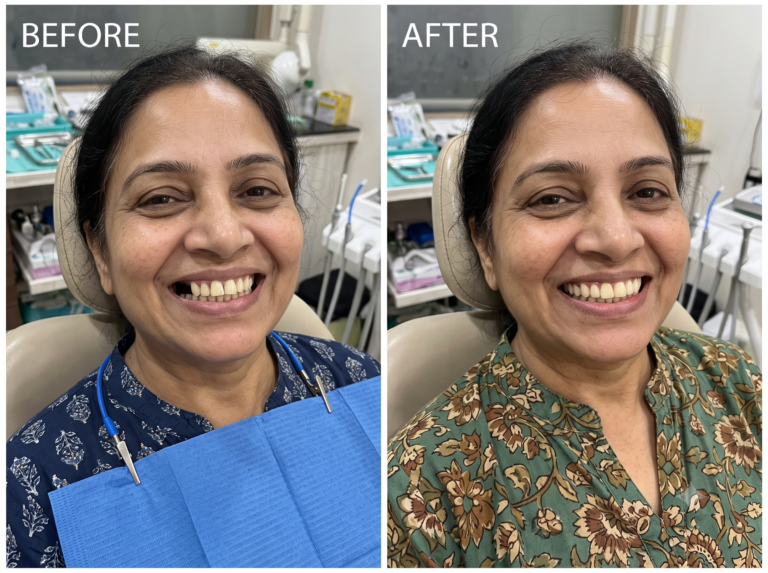 Partial or flexible denture: before and after (illustration)