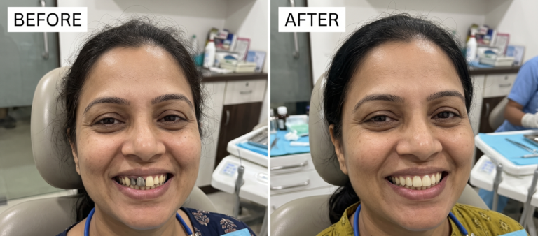 Front tooth crown: before and after (illustration)