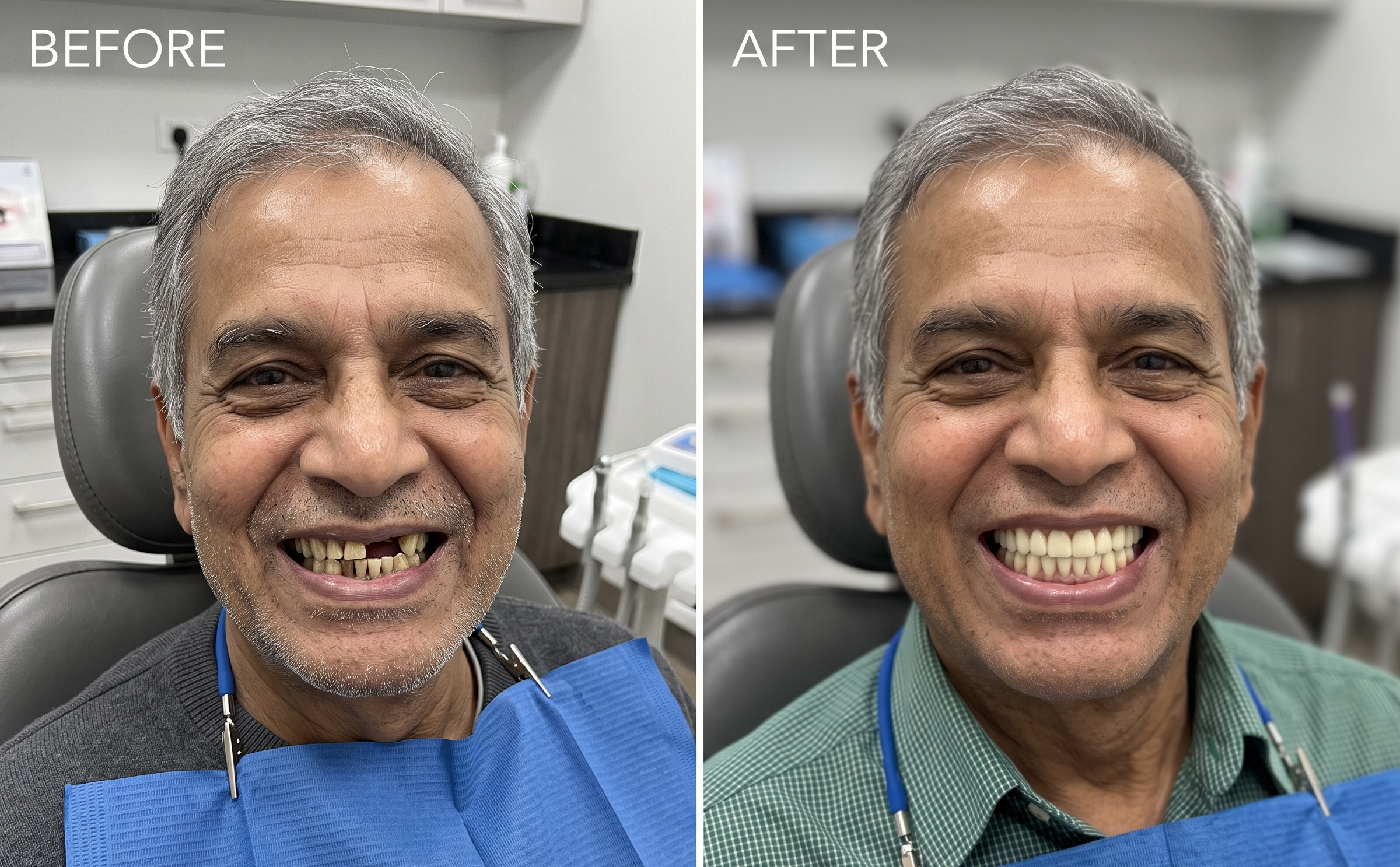 Before and after implant-supported fixed teeth for a complete jaw