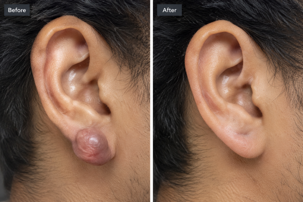 Earlobe after removal of a keloid on the ear. Illustrative image.