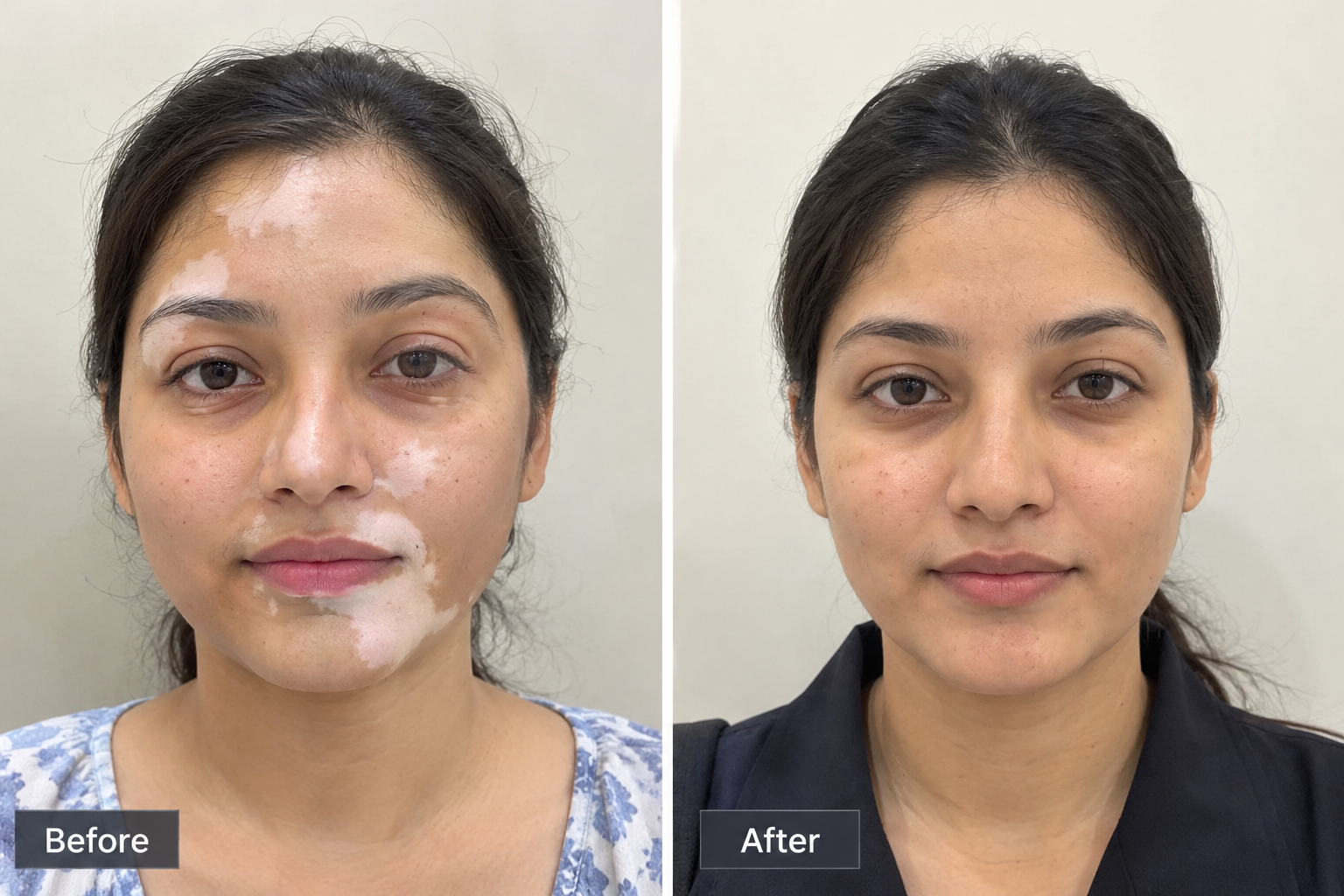 Vitiligo melanocyte transplant before and after at Sharanya Skin Clinic