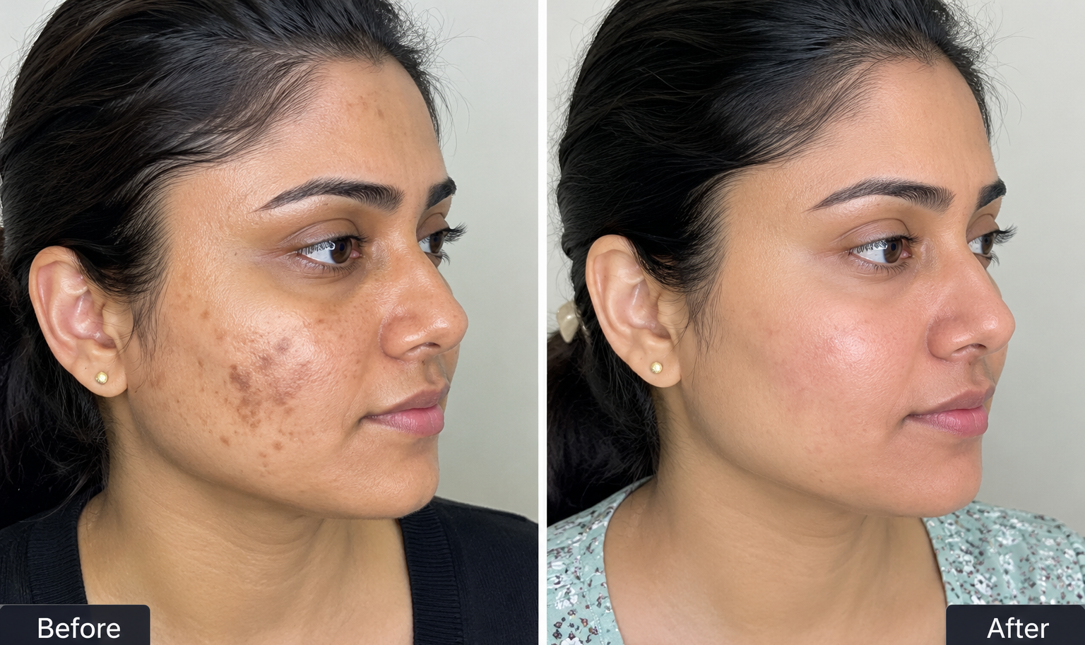 Pigmentation and dark spot treatment before and after at Sharanya Skin Clinic