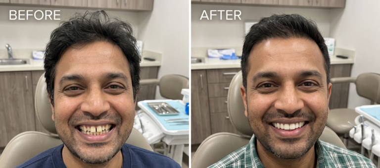 E-max or porcelain veneers: before and after (illustration)