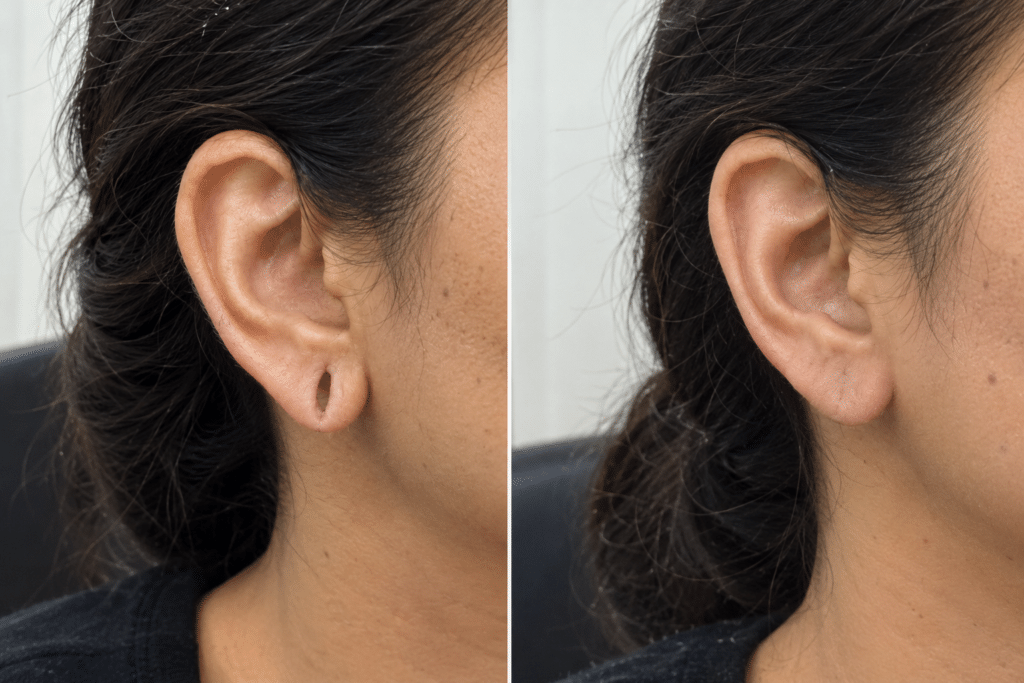 After ear hole repair: the split is closed and the earlobe has a natural shape. Illustrative image.