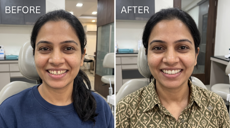 Composite veneers: before and after (illustration)