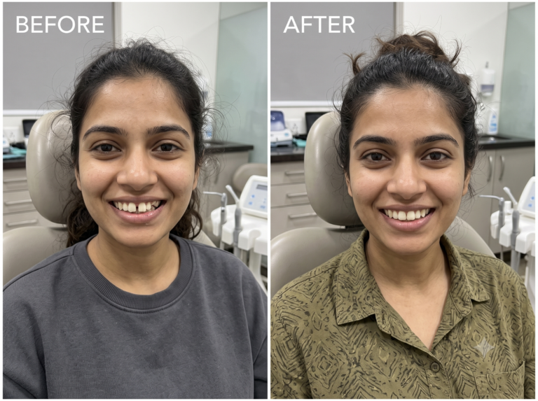 Gaps or chipped front teeth: before and after (illustration)